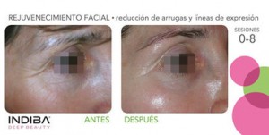 Indiba facial - Alicante